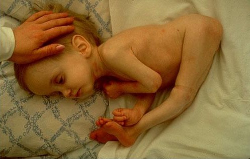 Nom : enfant tchernobyl 1.jpg
Affichages : 320
Taille : 36,7 Ko